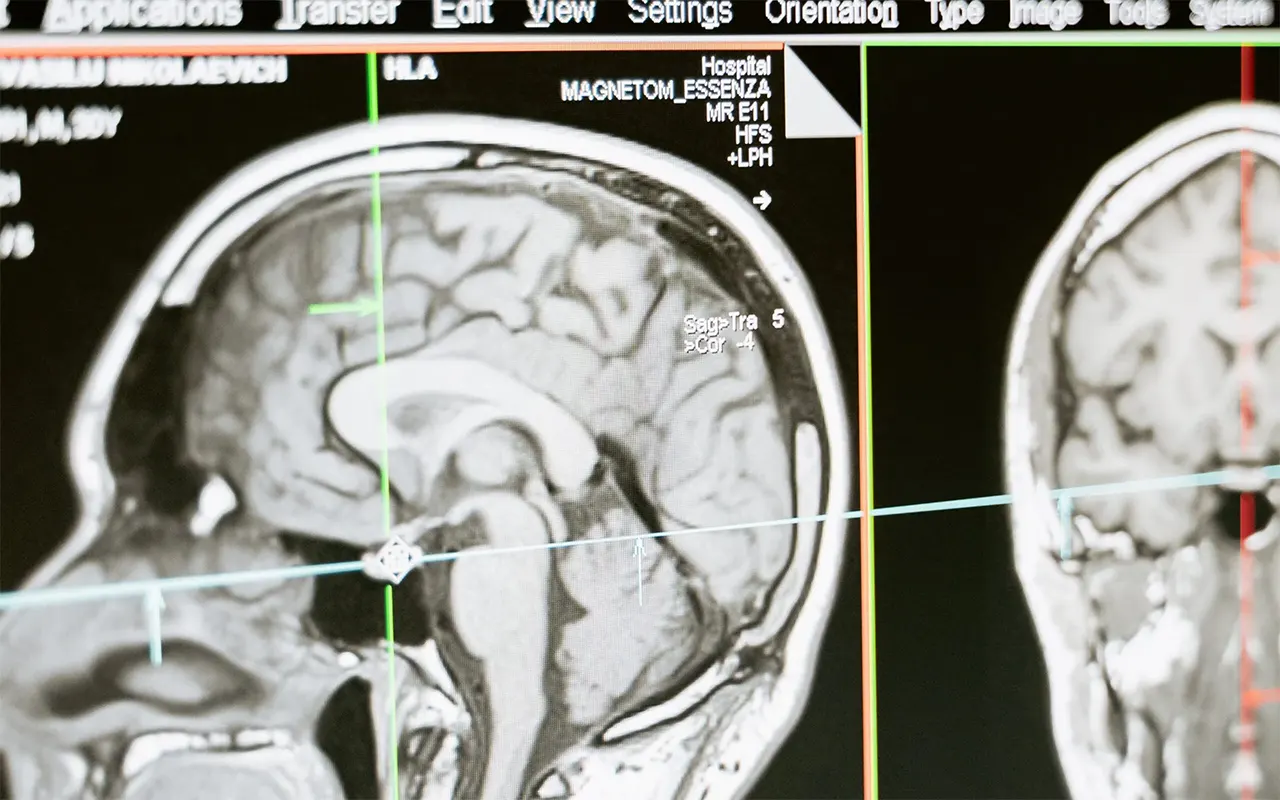 Univerzitet Stanford implantima u mozgu vratio izgubljene funkcije pacijentima sa povredama glave